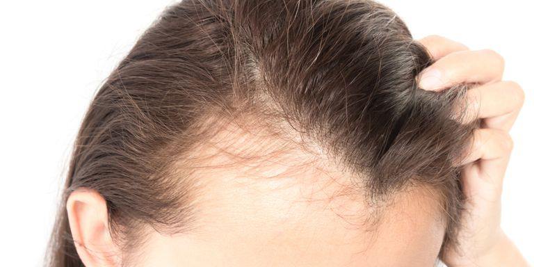 Alopecia nerviosa o por estrés -